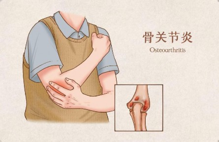 生活中怎樣預(yù)防骨關(guān)節(jié)炎？