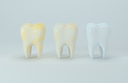 牙齒淡黃色才是健康色號？醫(yī)生提醒：洗牙并不能使牙齒變白