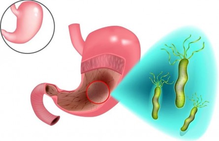 守“胃”健康，這些護(hù)胃措施請(qǐng)收好