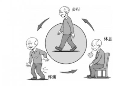 健康問答|什么是間歇性跛行？