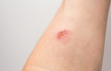 辟謠|燙傷后，可用白糖急救？