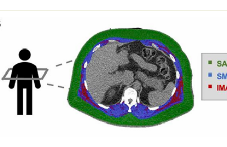 骨骼肌肌間脂肪多，心血管病風(fēng)險高